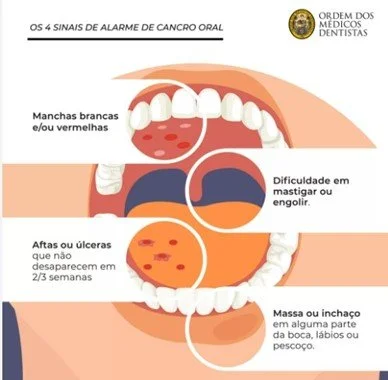 Cancro Oral