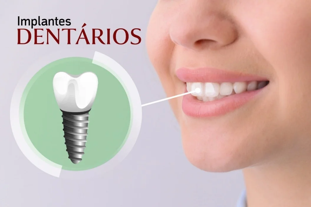 Vantagens do tratamento com implantes
