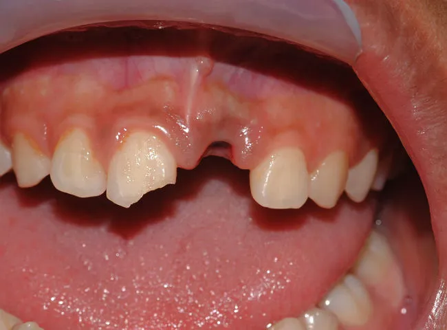O seu filho caiu e o dente saiu completamente