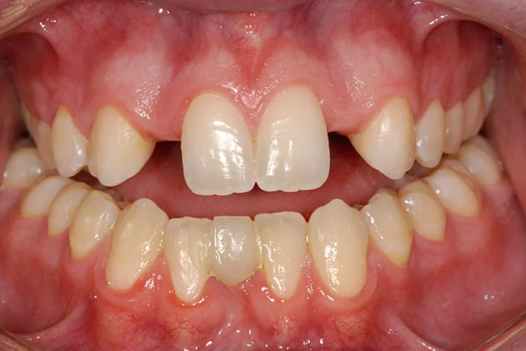 Dentes a mais ou dentes a menos?