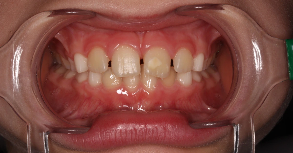 Manchas brancas/castanhas nos incisivos e molares