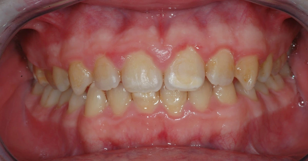 Manchas brancas/castanhas nos incisivos e molares