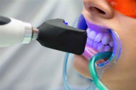 Branqueamento Dentário – Qual deles?