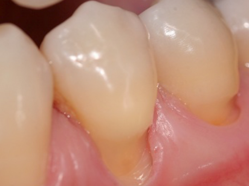 Lesões não cariosas